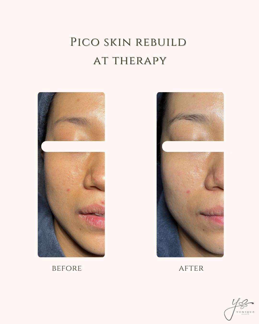 Pico Skin Rebuild AT Therapy 植物海绵微针皮肤重建护理