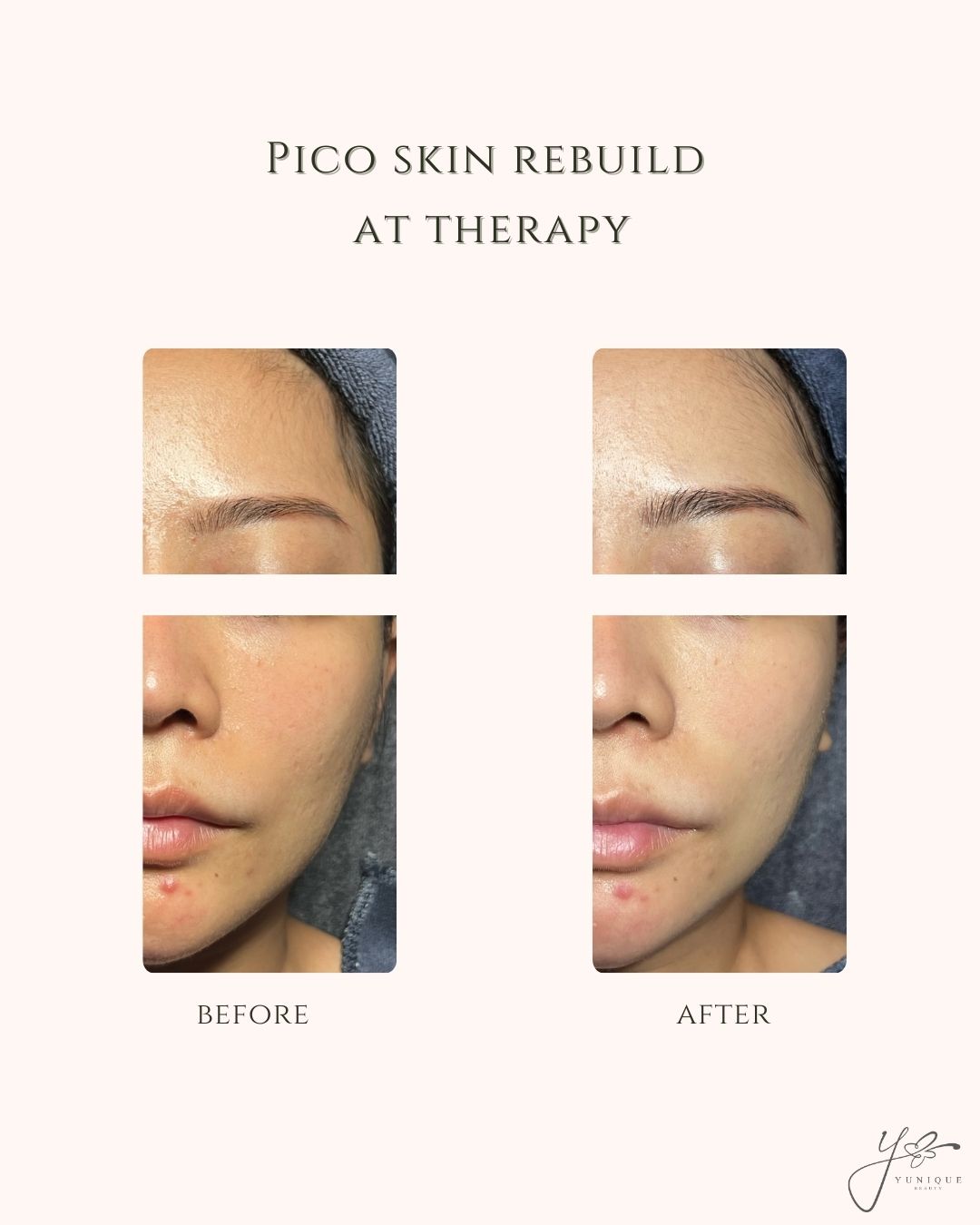 Pico Skin Rebuild AT Therapy 植物海绵微针皮肤重建护理